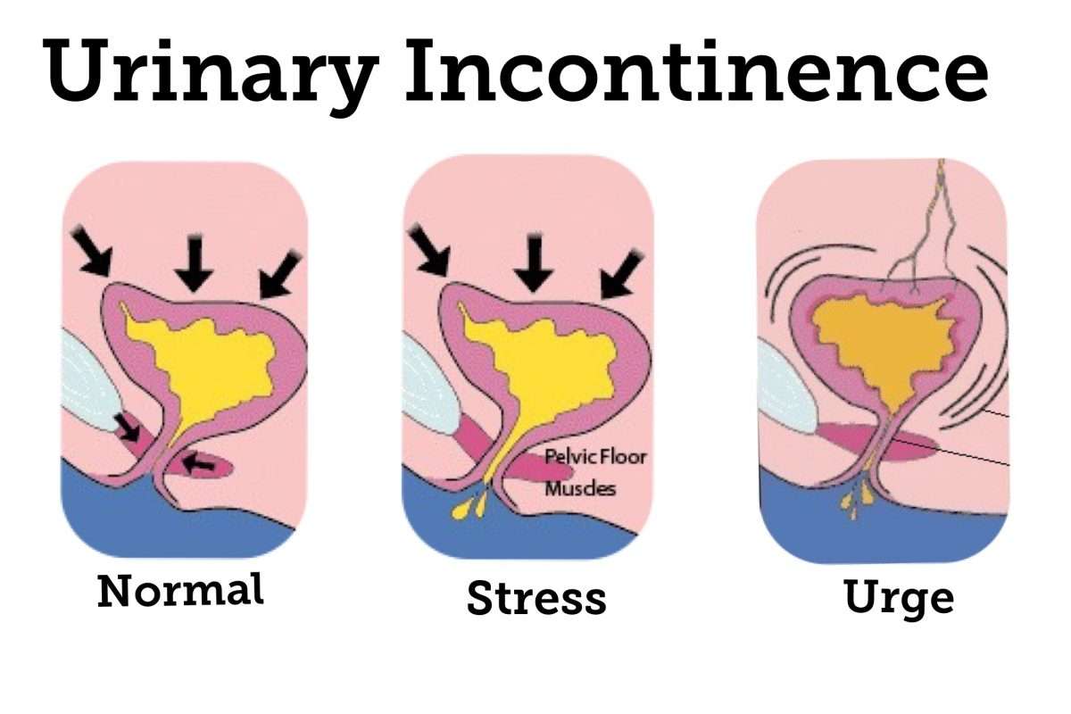 Urinary Incontinence FAQ