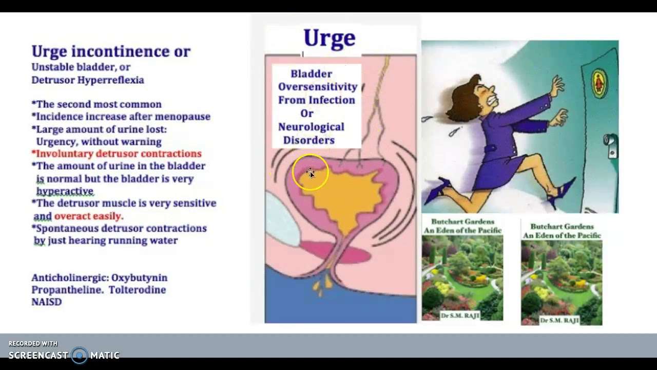 Urinary Incontinence USMLE Types Stress Urge Overflow Female Bladder ...