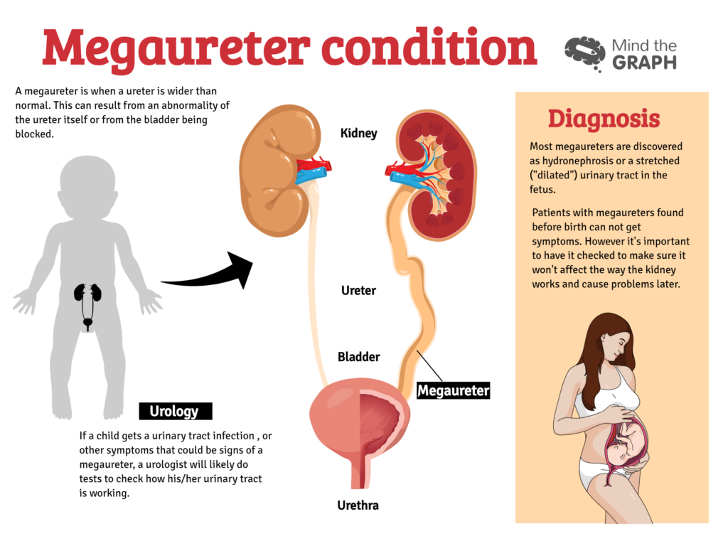 Urinary system diseases: Infographics to understand