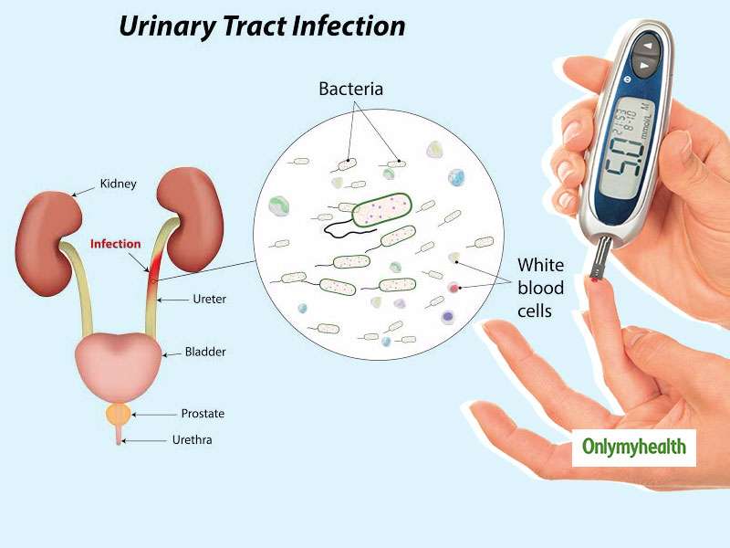 Urinary Tract Infection And Diabetes: Join The Missing Dots With Dr ...