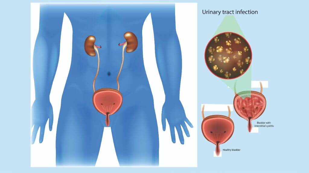 Urinary Tract Infection: Causes, Symptoms, and Long