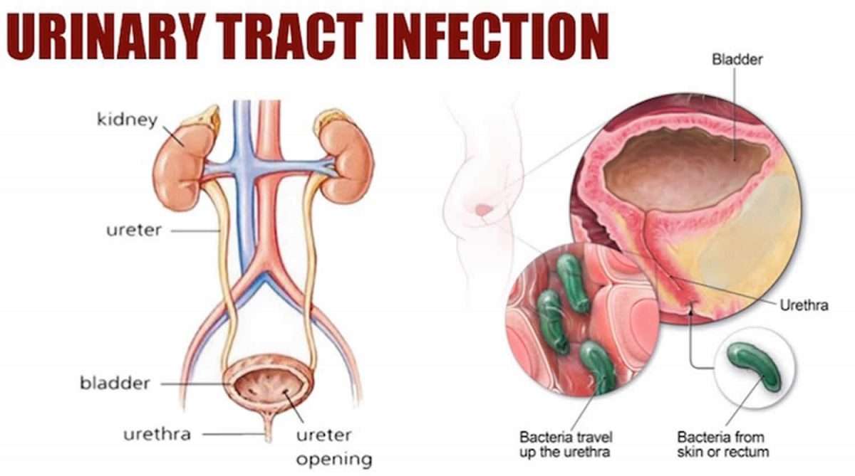 Urinary tract infection causes, symptoms, diagnosis, prevention &  treatment