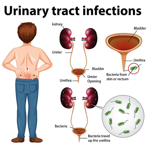 Urinary Tract Infection in men  symptoms, causes and treatment ...