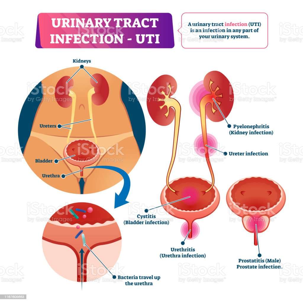 Urinary Tract Infection Or Uti Vector Illustration Labeled Medical ...