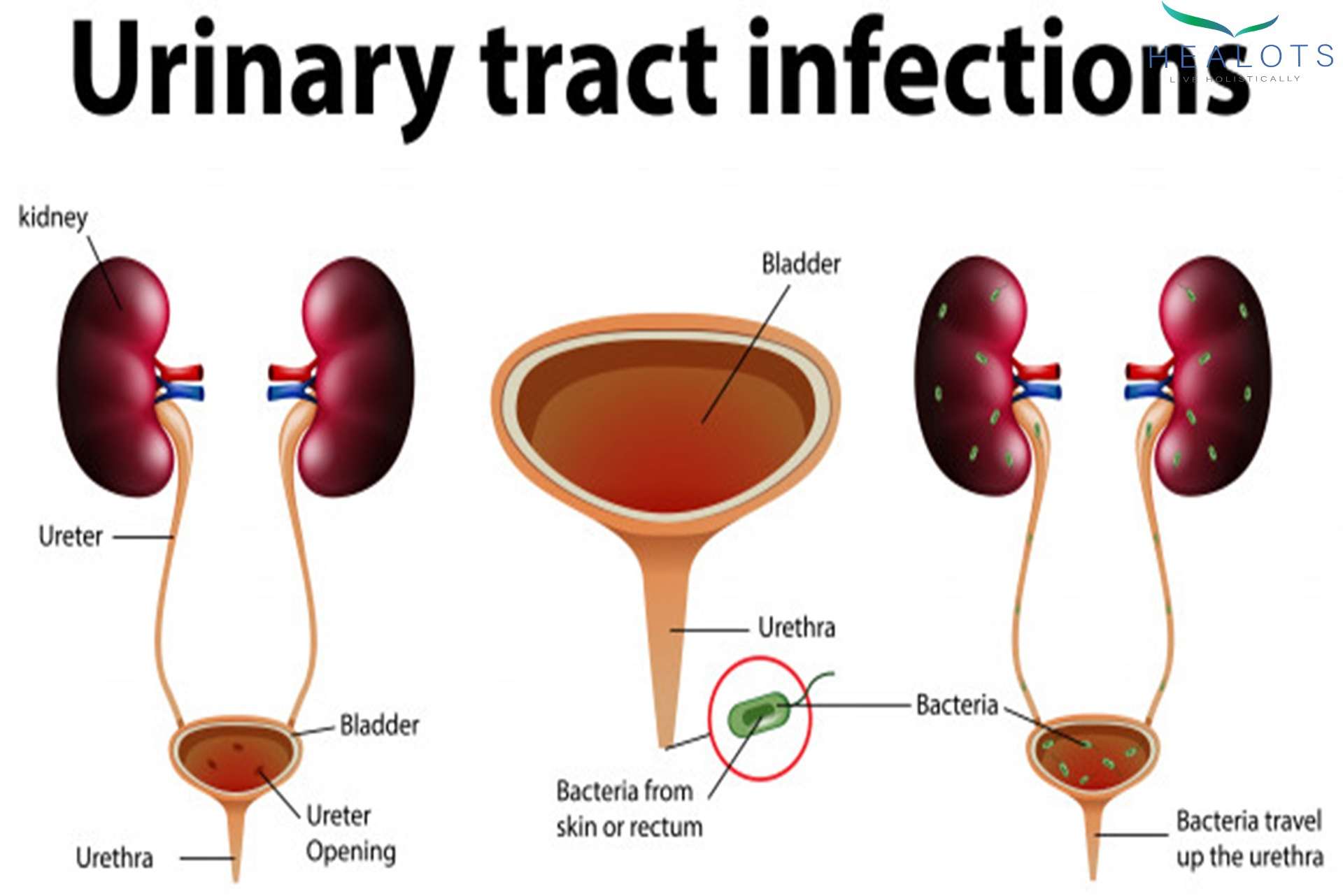 Urinary tract infection  should have been concerned ...