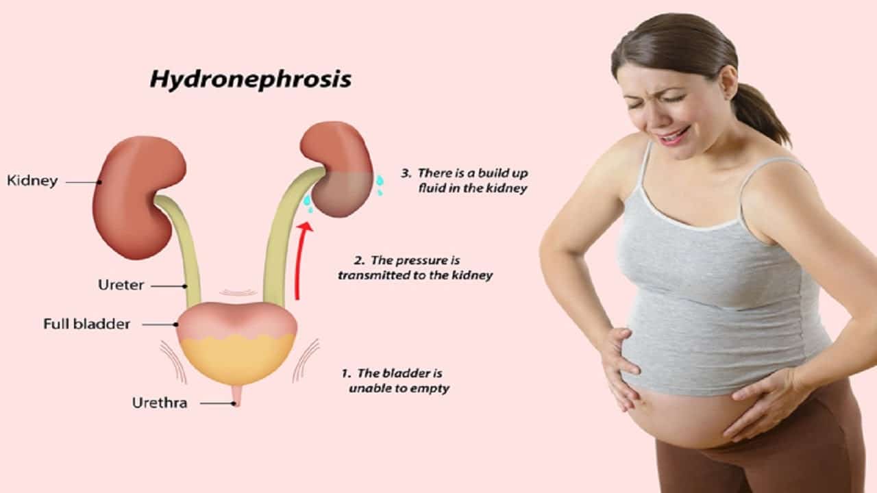 Urinary Tract Infection (UTI) In Pregnancy: Symptoms &  Treatment