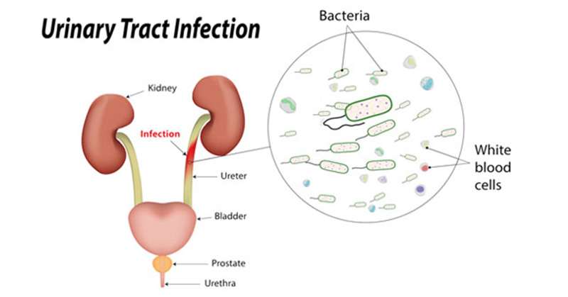 Urinary Tract Infection (UTI) Symptoms