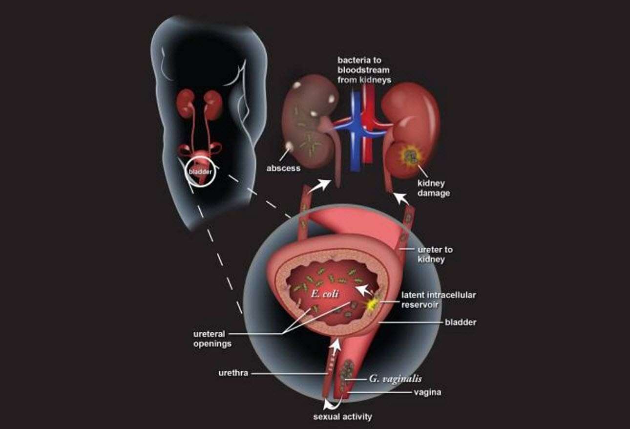 Urinary Tract Infections: A Spectrum of Pathologies and ...