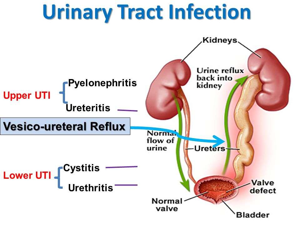 Urinary Tract Infections: All that You Need to Know