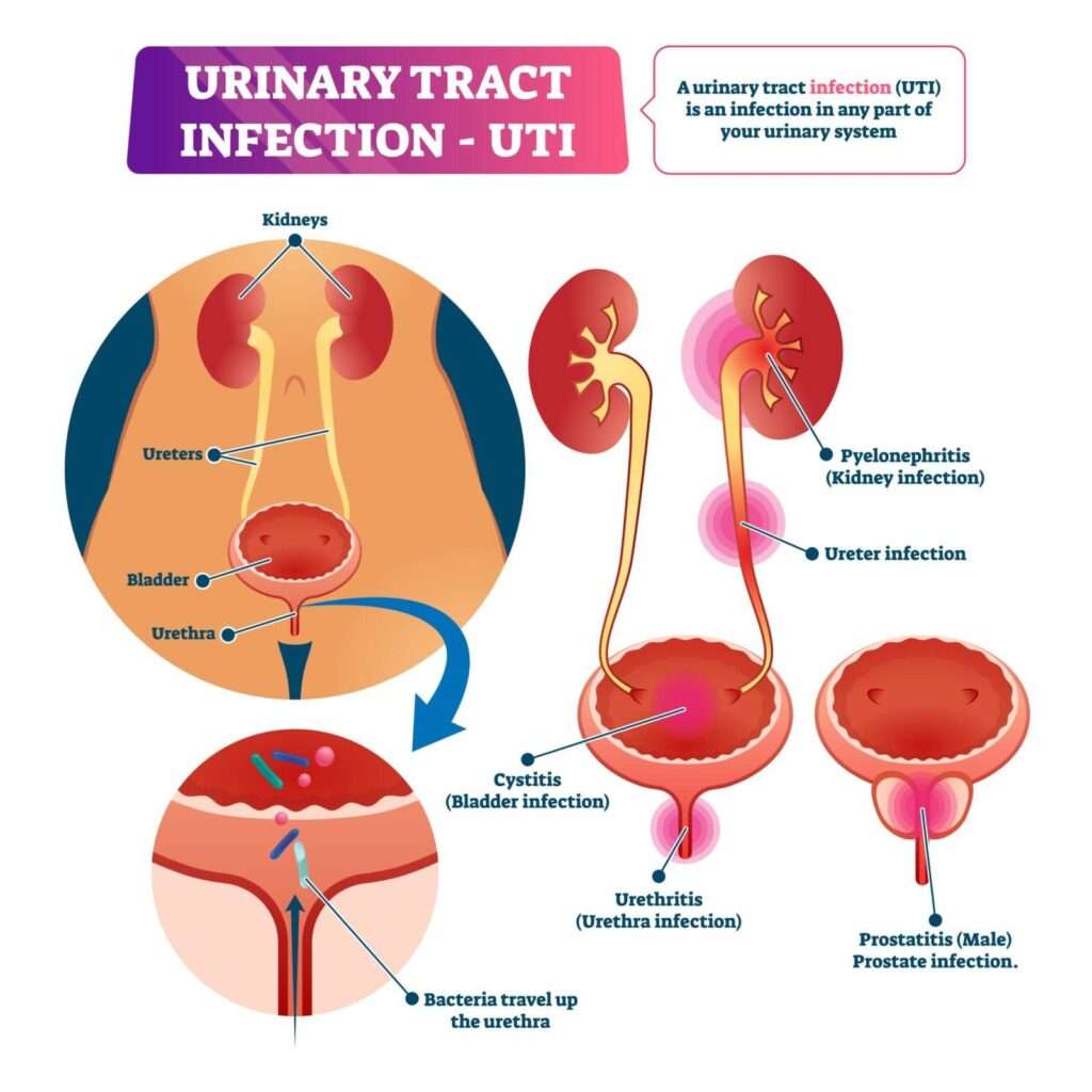 Urinary Tract Infections / Emed Primary Care Clinic Jacksonville