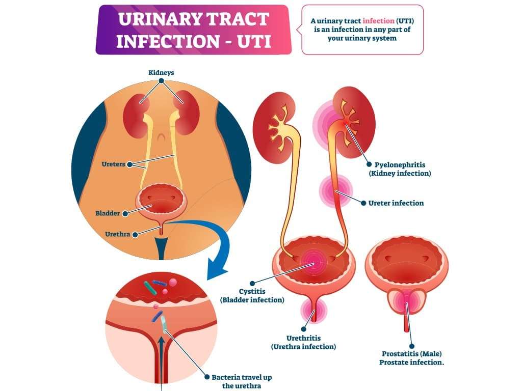 Urinary Tract Infections Following a Spinal Cord Injury