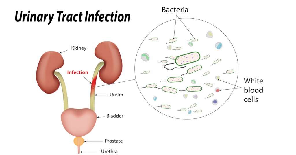 Urinary Tract Infections (UTIs) Symptoms &  Causes