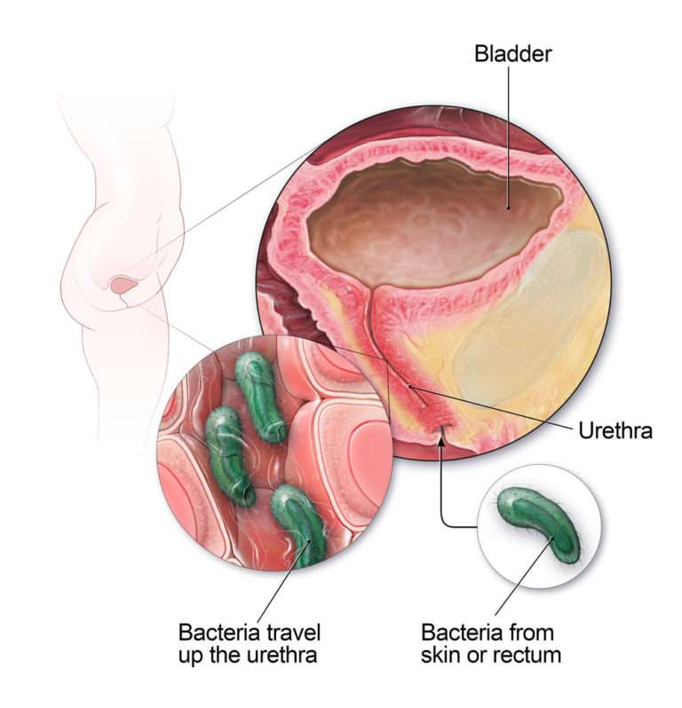 Urine Infection in Women