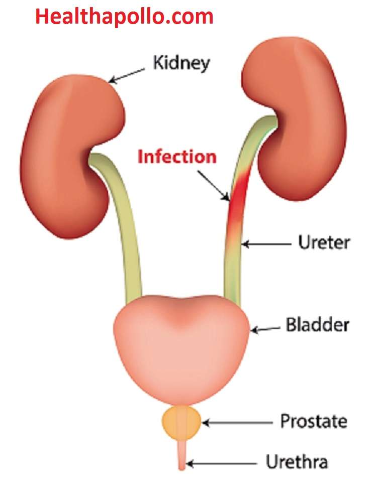 UTI ( Urinary Tract Infection) Causes, Symptoms and Home remedies