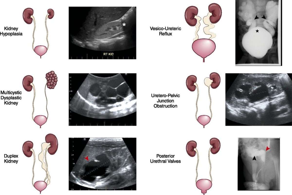 [View 46+] Get Posterior Urethral Valve Obstruction In Fetus Png vector