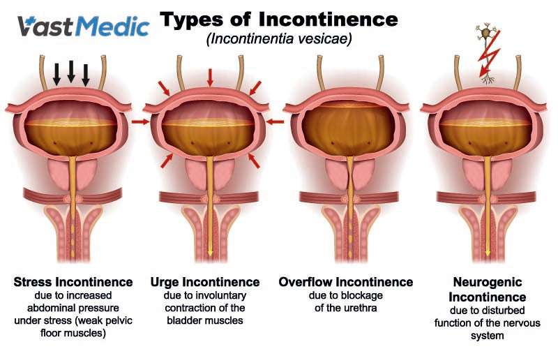 What Is Male Bladder Incontinence? â Vastmedic