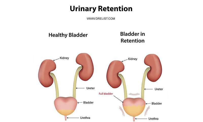 What Is Urinary Retention?