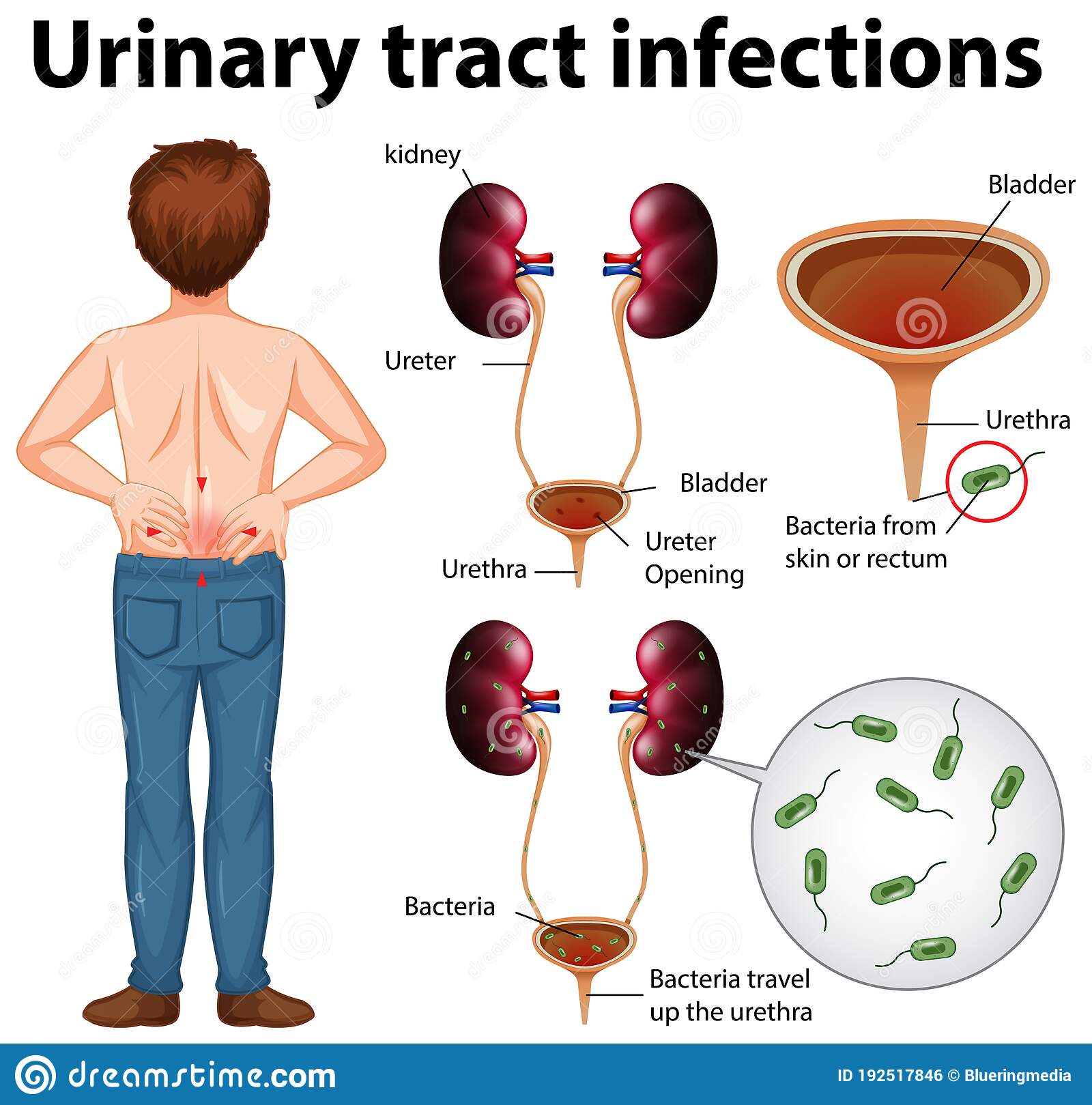 Why Am I Getting Urinary Tract Infections