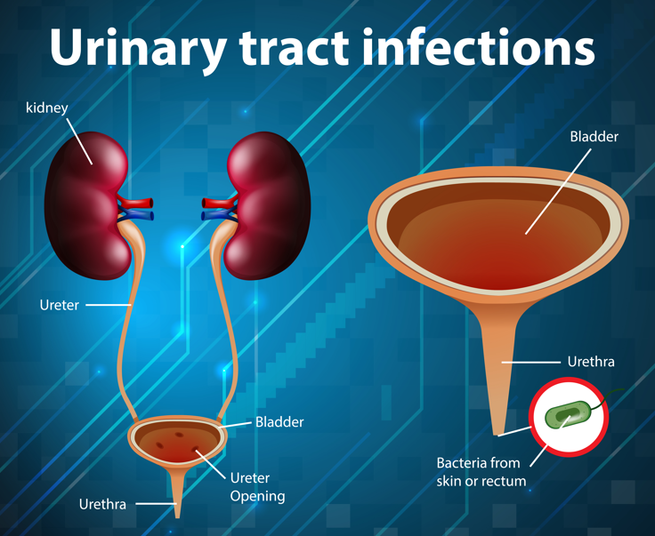 WHY DO I KEEP GETTING URINARY TRACT INFECTIONS?